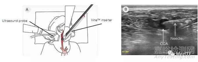 Vine:螺旋型過濾器 預(yù)防中風(fēng)
