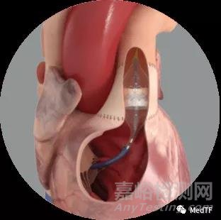 SAPIEN 3 與ALTERRA：愛德華肺動脈瓣獲FDA批準(zhǔn) 挑戰(zhàn)美敦力