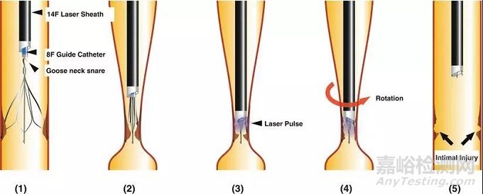 CavaClear:飛利浦激光輔助移除IVC過濾器產(chǎn)品獲FDA批準(zhǔn)