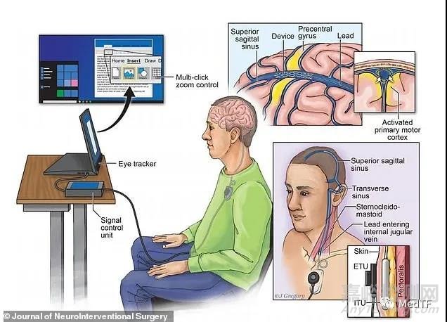 Stentrode:首位植入腦機(jī)接口的患者通過Twitter發(fā)布信息