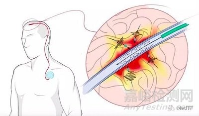 Stentrode:首位植入腦機(jī)接口的患者通過Twitter發(fā)布信息