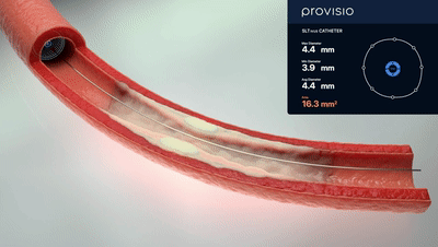SLT IVUS：具有聲吶功能IVUS 實時提供血管流腔尺寸