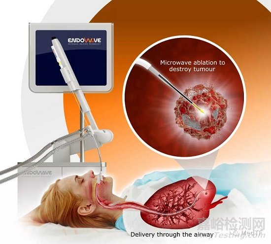 Endowave System：柔性微波消融導(dǎo)管 經(jīng)支氣管治療肺癌