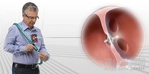 V-LAP:世界上首臺心內(nèi)微型計算機 實時監(jiān)測心衰