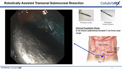 Endoluminal Surgical：消化內(nèi)科軟體機(jī)器人