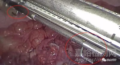 LAP IA 60:首個(gè)實(shí)現(xiàn)腔鏡下結(jié)腸吻合的腔鏡吻合器