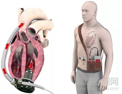 FiVAD：無線心室輔助裝置 完成臨床前研究