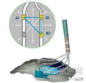 EnSite X EP：雅培最先進(jìn)的三維標(biāo)測獲FDA批準(zhǔn)