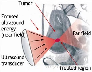 外科能量醫(yī)療器械技術(shù)全面解讀