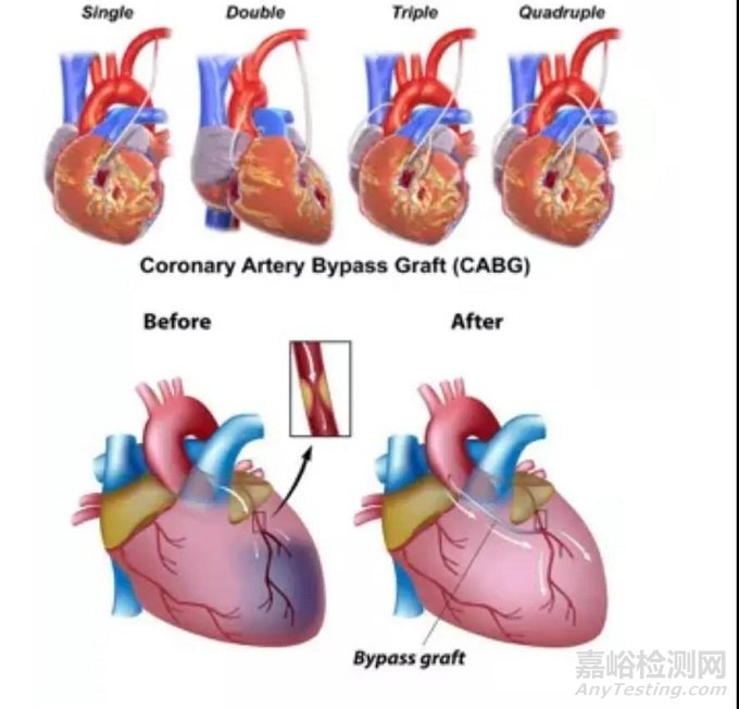 中美人工血管新產(chǎn)品與新技術(shù)