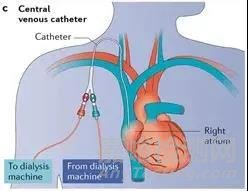 中美人工血管新產(chǎn)品與新技術(shù)