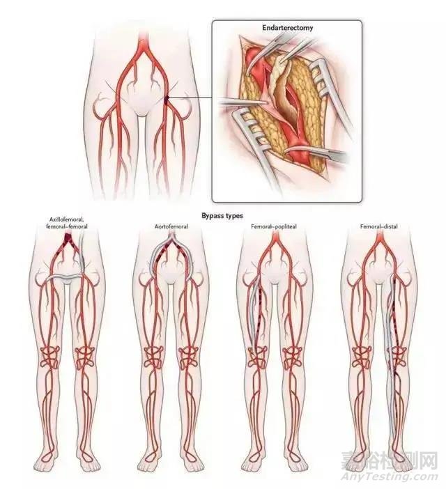中美人工血管新產(chǎn)品與新技術(shù)