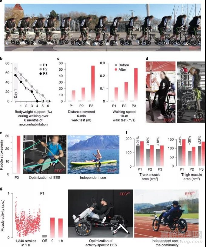 ONWARD脊髓電刺激:術(shù)后一天內(nèi)即可讓癱瘓患者(脊髓損傷)重新獨(dú)立行走