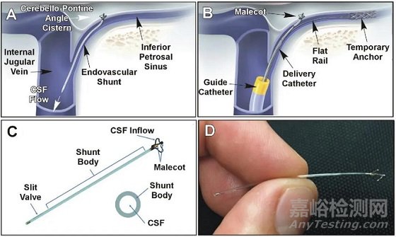 eShunt :介入腦積水分流管 由神外轉(zhuǎn)神內(nèi)