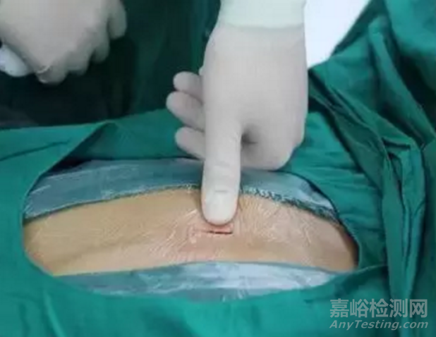 全球首款！全降解封堵器正式獲批