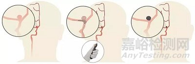 Comaneci:?腦血管痙攣治療支架獲FDA“突破性設(shè)備”稱號(hào)