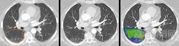 西門(mén)子光子計(jì)數(shù)CT獲國(guó)家局批準(zhǔn)