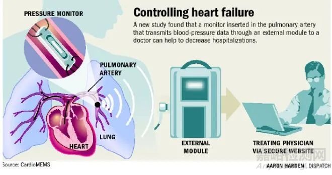 CardioMEMS:FDA批準(zhǔn)用于 II 級(jí)心衰患者