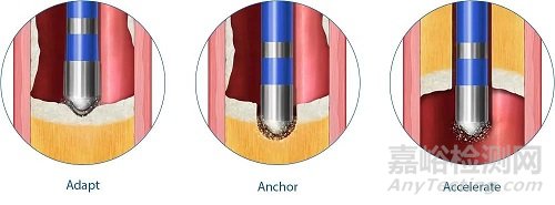 Crosser iQ CTO:BD全新的不損傷血管的CTO技術(shù)