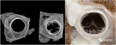 TRIA:首款經(jīng)導管的生物聚合物瓣來了