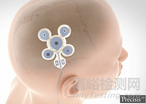 EASEE：創(chuàng)新癲癇神經(jīng)刺激系統(tǒng)無需開顱