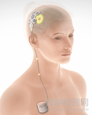 EASEE：創(chuàng)新癲癇神經(jīng)刺激系統(tǒng)無需開顱