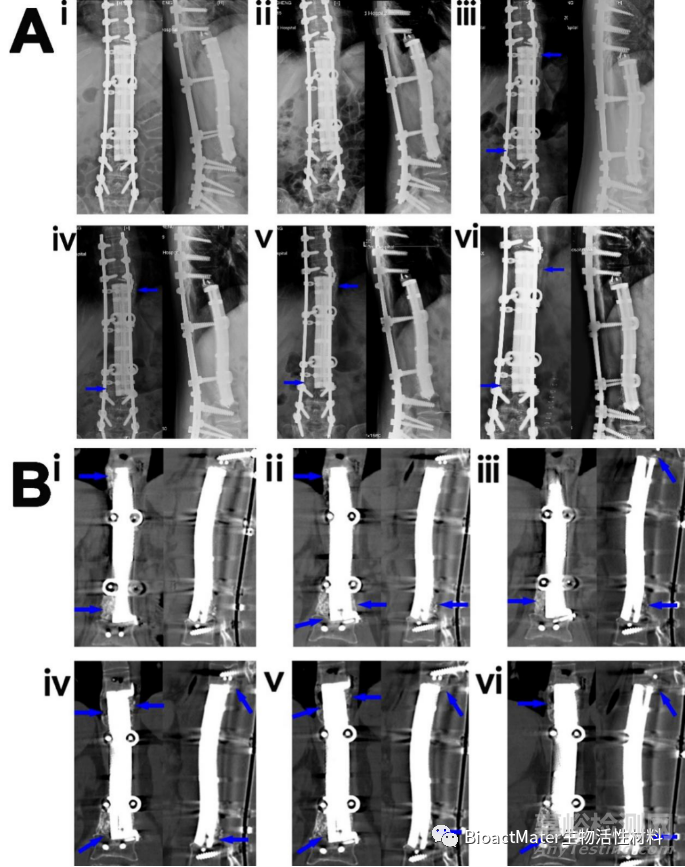 應(yīng)用3D打印多孔鈦合金內(nèi)植物橋接骨缺損區(qū)并成就內(nèi)植物-骨界面融合