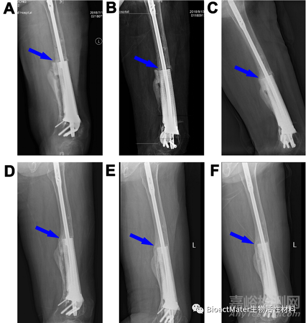 應(yīng)用3D打印多孔鈦合金內(nèi)植物橋接骨缺損區(qū)并成就內(nèi)植物-骨界面融合