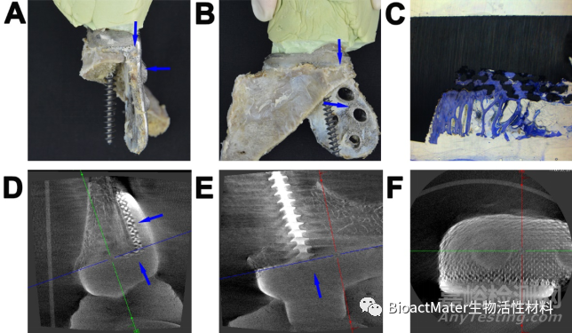 應(yīng)用3D打印多孔鈦合金內(nèi)植物橋接骨缺損區(qū)并成就內(nèi)植物-骨界面融合