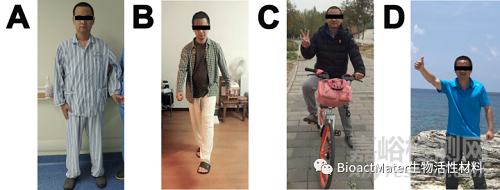 應(yīng)用3D打印多孔鈦合金內(nèi)植物橋接骨缺損區(qū)并成就內(nèi)植物-骨界面融合