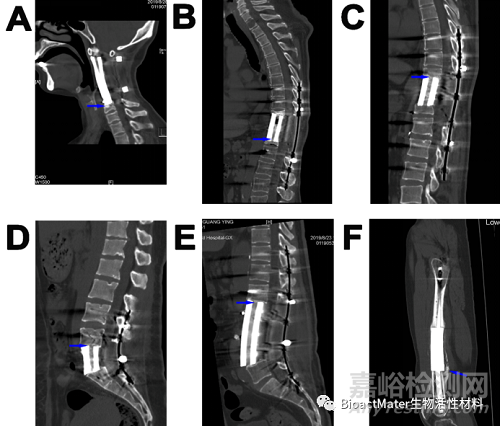 應(yīng)用3D打印多孔鈦合金內(nèi)植物橋接骨缺損區(qū)并成就內(nèi)植物-骨界面融合