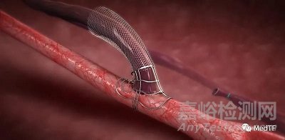 VasQ：血管外支架最大真實(shí)世界研究 證實(shí)長(zhǎng)期收益