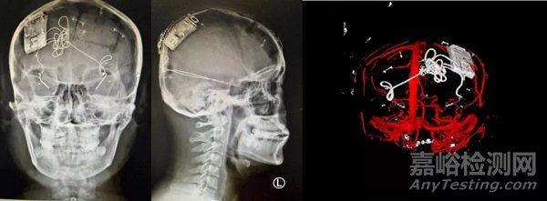 宣武醫(yī)院完成中國首例“腦機(jī)接口”反應(yīng)性閉環(huán)神經(jīng)刺激系統(tǒng)的3期臨床植入手術(shù)