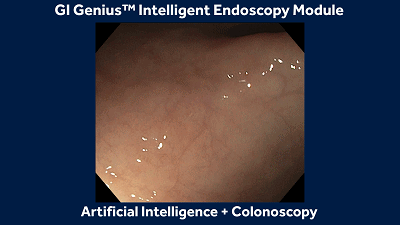 GI Genius:美敦力臨床研究證實人工智能輔助內鏡診斷能減少一半漏診