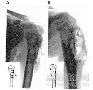 可降解醫(yī)用鎂基金屬骨科材料研究進展