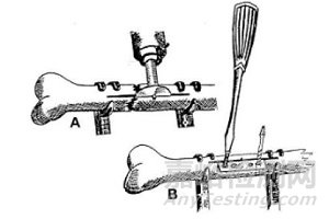 可降解醫(yī)用鎂基金屬骨科材料研究進展