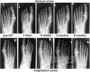 可降解醫(yī)用鎂基金屬骨科材料研究進展