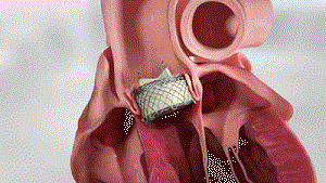 可回收的適用于反流的TAVR