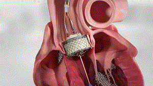 可回收的適用于反流的TAVR