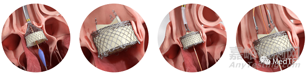 可回收的適用于反流的TAVR