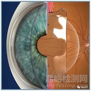 EVO:FDA批準(zhǔn)最新可植入隱形眼鏡