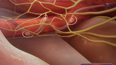 美敦力公布RDN最新臨床數(shù)據(jù)