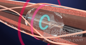 腎動(dòng)脈消融器械技術(shù)解析