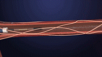 腎動(dòng)脈消融器械技術(shù)解析