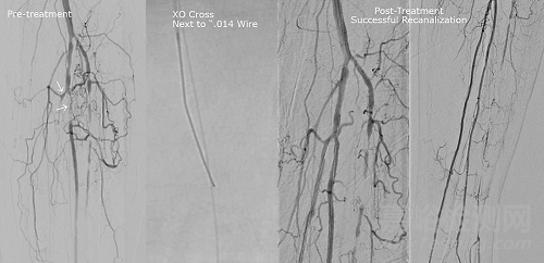 新型冠狀動(dòng)脈微支撐導(dǎo)管獲FDA批準(zhǔn)