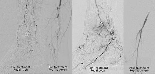 新型冠狀動(dòng)脈微支撐導(dǎo)管獲FDA批準(zhǔn)