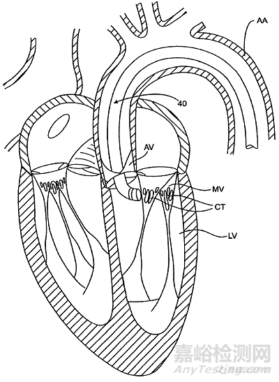 心臟瓣膜之二尖瓣技術(shù)解析