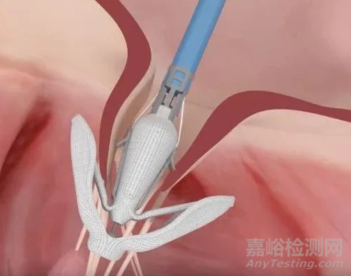 心臟瓣膜之二尖瓣技術(shù)解析