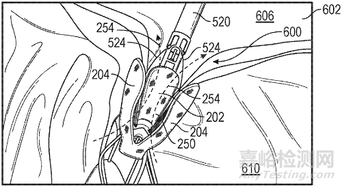 心臟瓣膜之二尖瓣技術(shù)解析