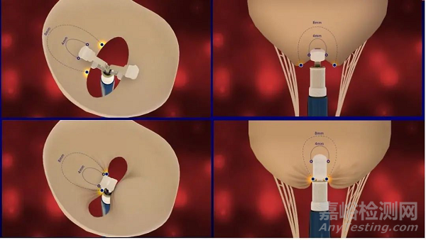 心臟瓣膜之二尖瓣技術(shù)解析